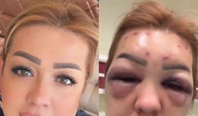 Botoks bu hale getirdi: Yüzü şişti tanınmayacak hale geldi